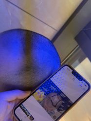 -碧莲盛·不剃发植发