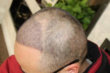 -大麦微针植发全国连锁