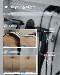 -半岛故事·法儿曼抗衰·indiba中心