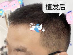 -大麦微针植发全国连锁