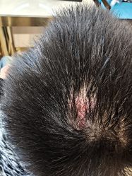 -碧莲盛·不剃发植发