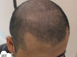 -大麦微针植发丨全国连锁