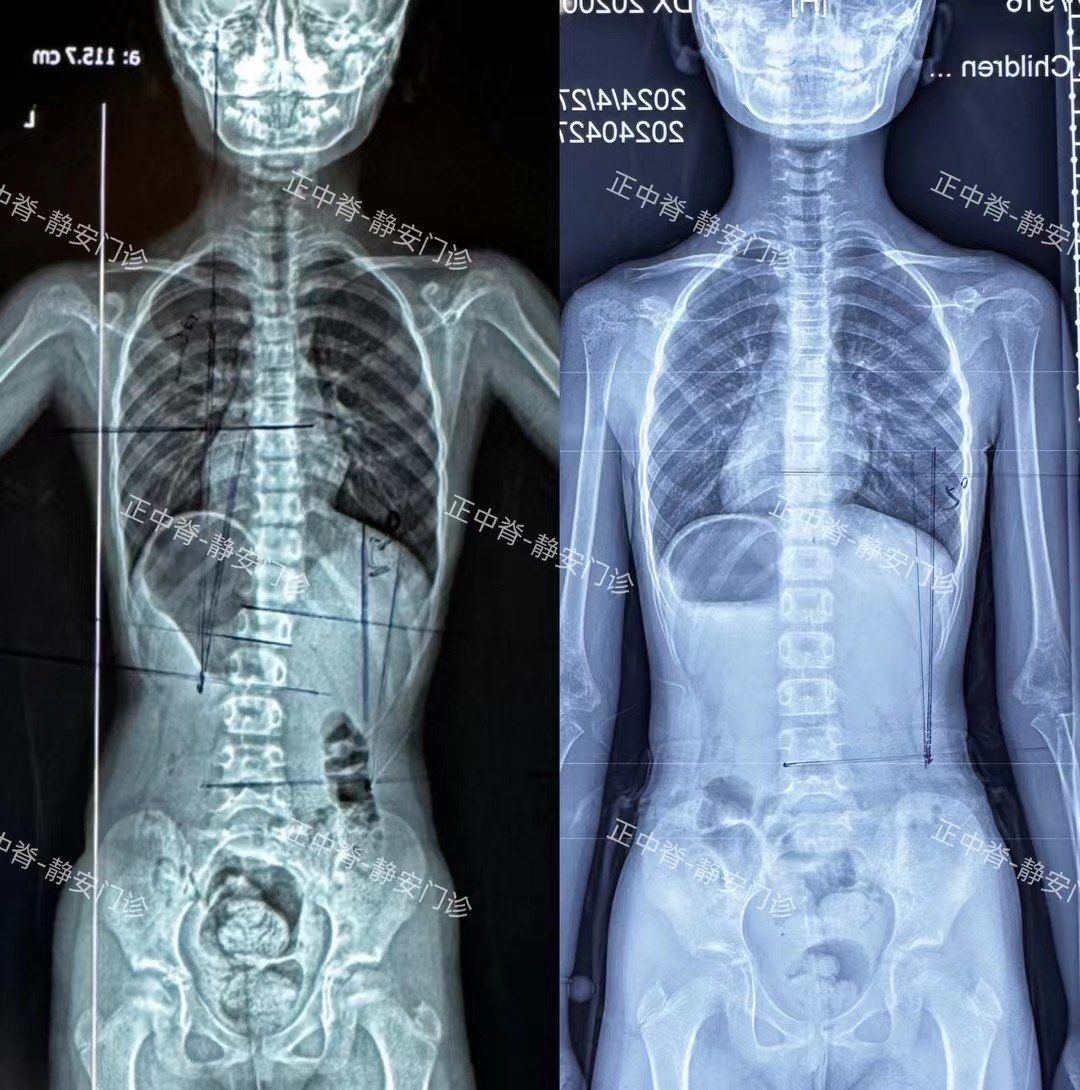 成长轨迹:骨骼x光对比