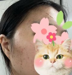 -肌密·水光·祛痘·黄金微针
