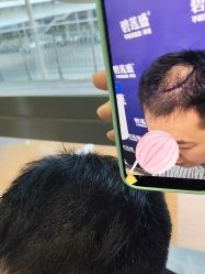 -碧莲盛·不剃发植发