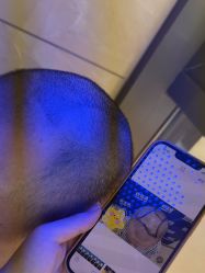 -碧莲盛·不剃发植发