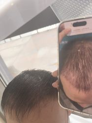 -碧莲盛·不剃发植发