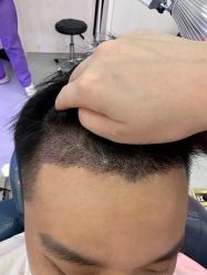 -大麦微针植发全国连锁