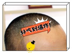 -大麦微针植发全国连锁