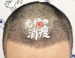 -大麦微针植发全国连锁