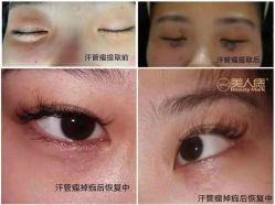 -美人痣全国连锁