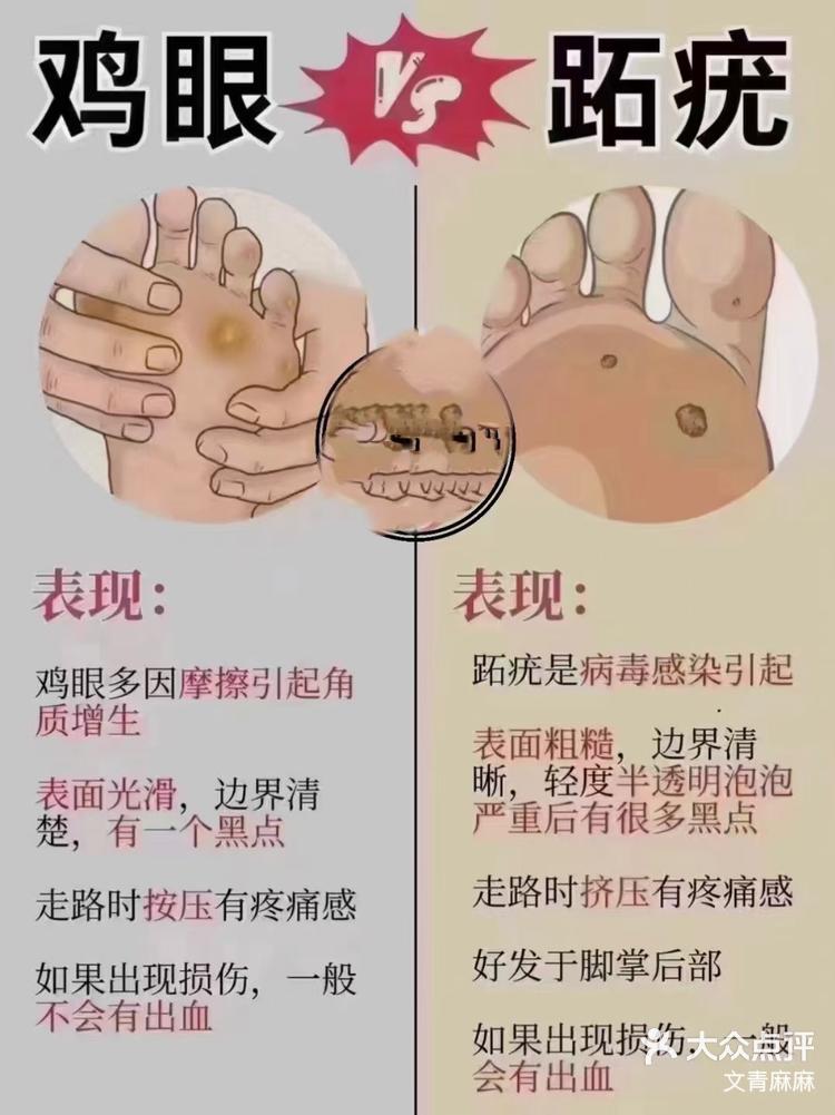 病毒疣怎么治能除根图片