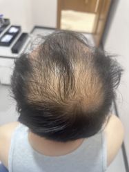 -大麦微针植发全国连锁