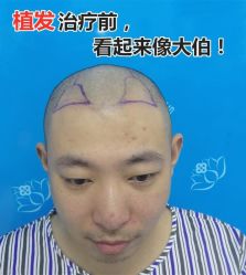 -碧莲盛·不剃发植发