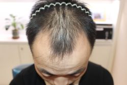 点击看大图 -大麦微针植发丨全国连锁