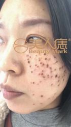 -美人痣全国连锁