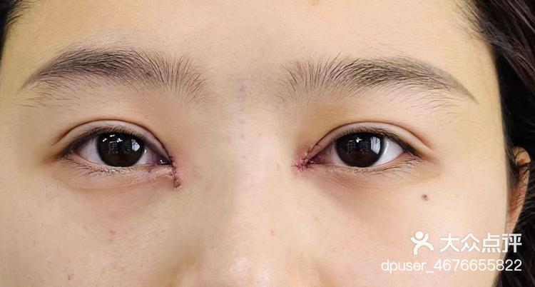 之前在开眼角的时候,眼角留疤导致了