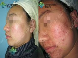 点击看大图 -瓷肌博士·祛痘科技美肤