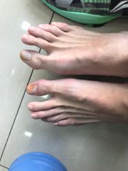 点击看大图 -德哥灰指甲脚气甲沟炎跖疣护理