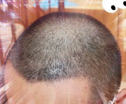 -大麦微针植发全国连锁