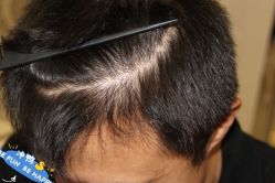 -大麦微针植发丨全国连锁