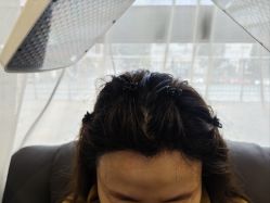 -碧莲盛·不剃发植发