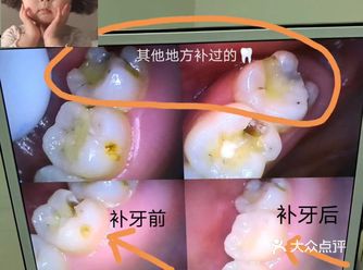小姐姐以前补过一次牙齿，因为平时没有重视每年的牙齿检