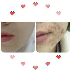 -痘博士烟台·全国连锁祛痘机构