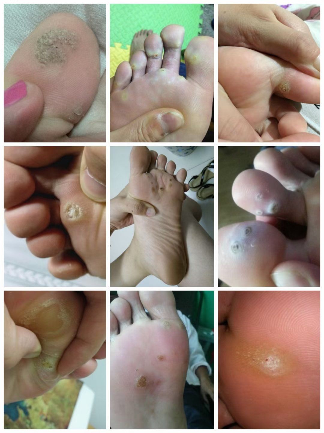 n
大部分的人得了就把他当鸡眼治疗,贴鸡眼膏越贴越大,然后慌隶去