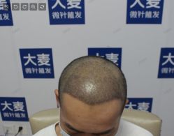 体验后-大麦微针植发丨全国连锁