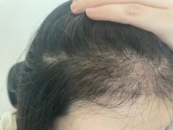 -碧莲盛·不剃发植发