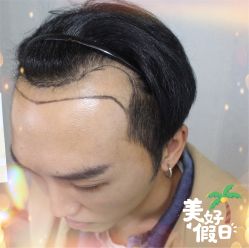 -大麦微针植发全国连锁