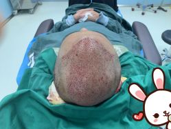 点击看大图 -大麦微针植发丨全国连锁