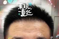 -大麦微针植发全国连锁