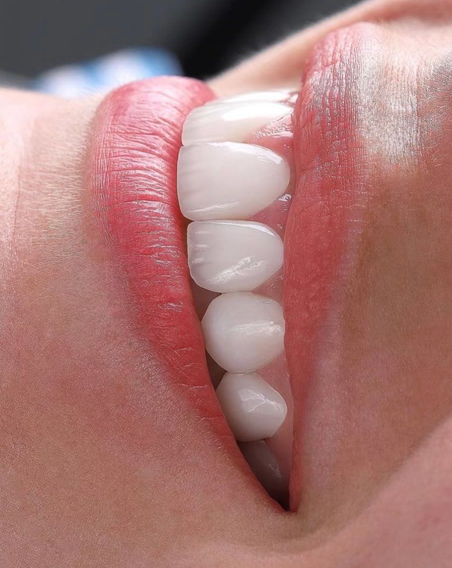 亮白牙齿自然闪耀