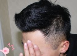 -大麦微针植发丨全国连锁