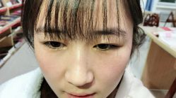 -美丽人生祛斑扁平疣汗管瘤中心