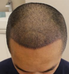 -大麦微针植发丨全国连锁