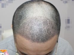 -大麦微针植发丨全国连锁