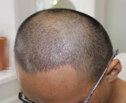 -大麦微针植发丨全国连锁