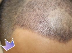 -大麦微针植发丨全国连锁