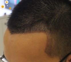 -大麦微针植发丨全国连锁