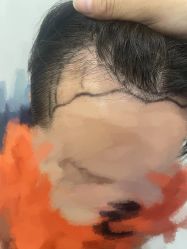 -大麦微针植发全国连锁