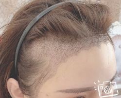 -大麦微针植发丨全国连锁