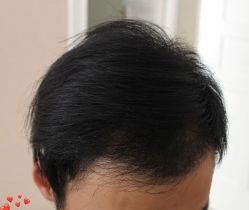 -大麦微针植发丨全国连锁