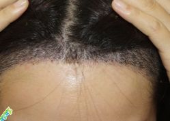 -大麦微针植发丨全国连锁