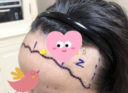 -大麦微针植发全国连锁