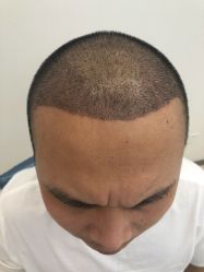 -大麦微针植发丨全国连锁