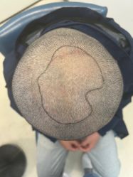 -大麦微针植发丨全国连锁