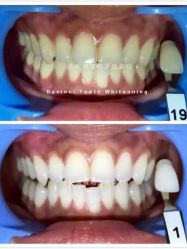 光SPA 牙齿美白-光SPA科技美肤